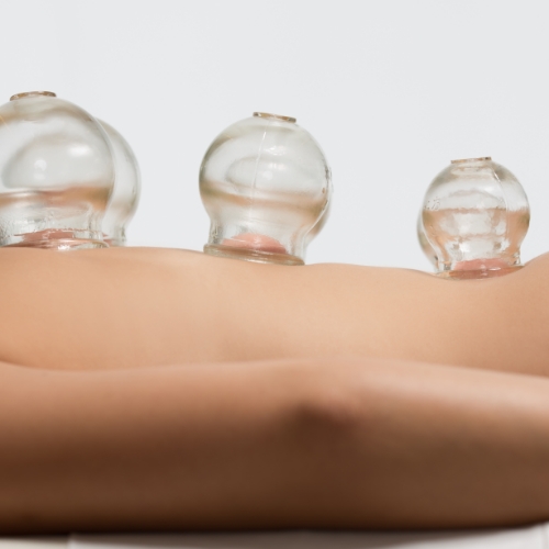 cupping-long-island-physical-therapy-huntington-station-ny
